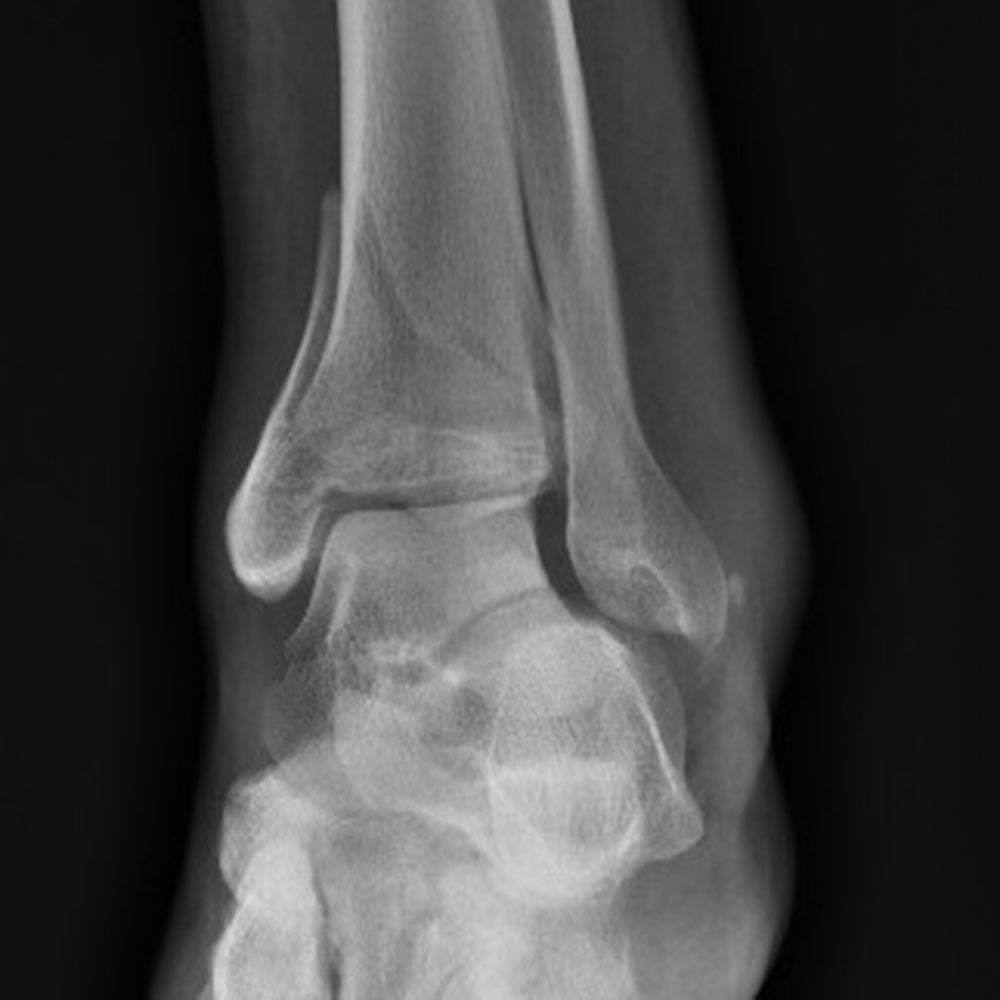 Lower limb fractures