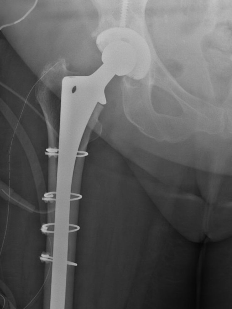 Revision Total Hip Replacement Dr Sunil Reddy