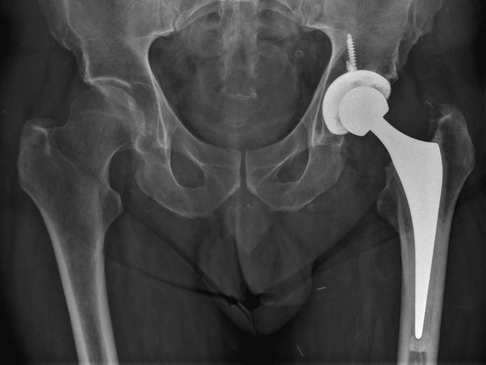 Total Hip Replacement 4 