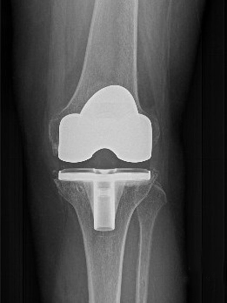 Bone model and X-ray image of a Total knee replacement prosthesis. 
